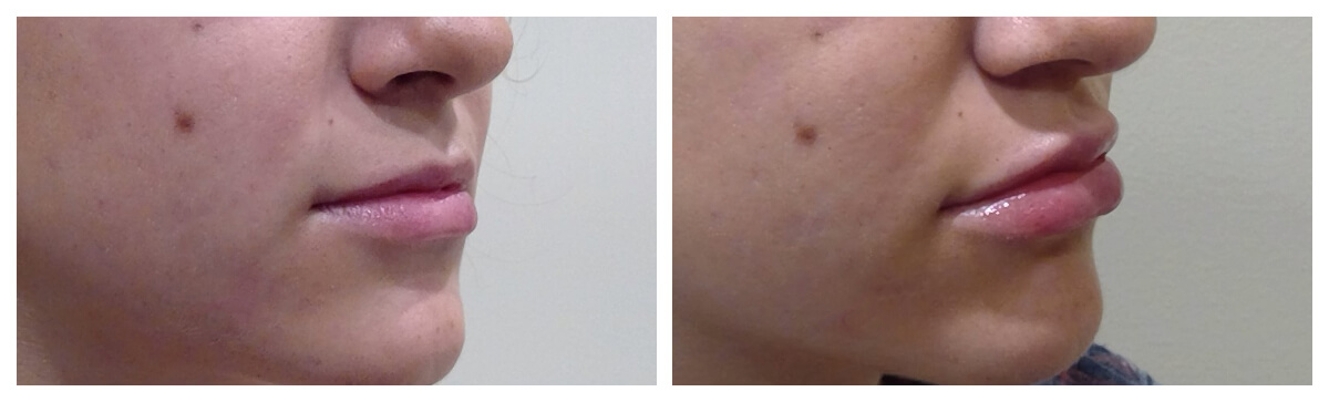 Example of Lip Fillers, Skinsational Medspa, Morgantown, WV