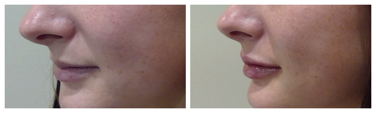 Example of Lip Augmentation in Morgantown, WV Skinsational Medspa